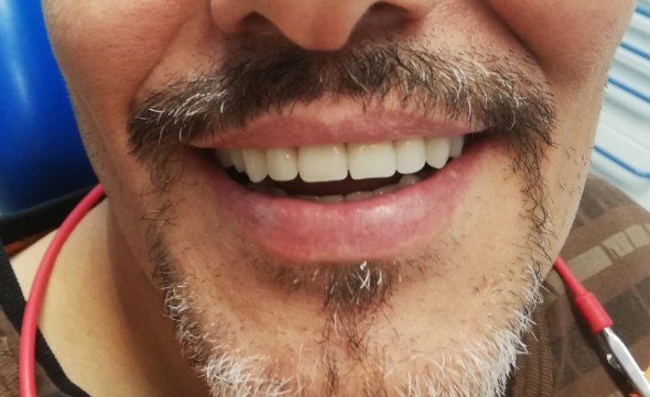Dopo — Carico immediato in giornata