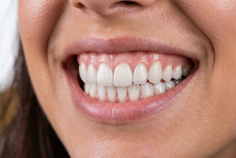Sorriso con faccette estetiche in zirconia